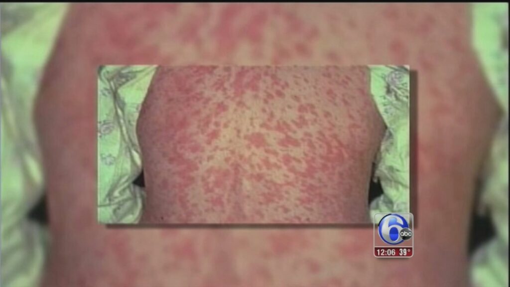 measles-outbreak-in-west-texas-understanding-the-urgency-of-vaccination